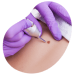 extirpacionlesioncutanea