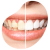 limpieza dental