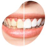 limpieza dental