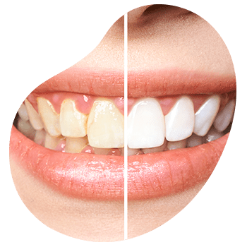 limpieza dental