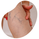 tratamiento varices escleroterapia microespuna y liquida